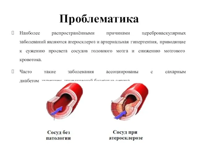 Проблематика Наиболее распространёнными причинами цереброваскулярных заболеваний являются атеросклероз и артериальная гипертензия,