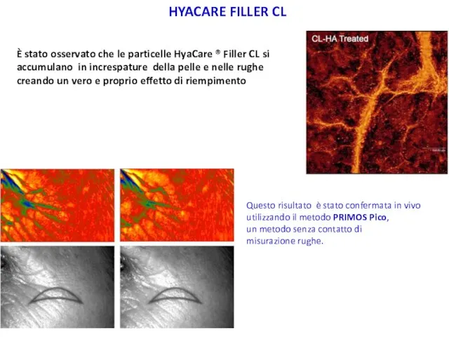 HYACARE FILLER CL È stato osservato che le particelle HyaCare ®