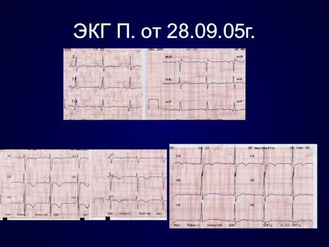 ЭКГ П. от 28.09.05г.