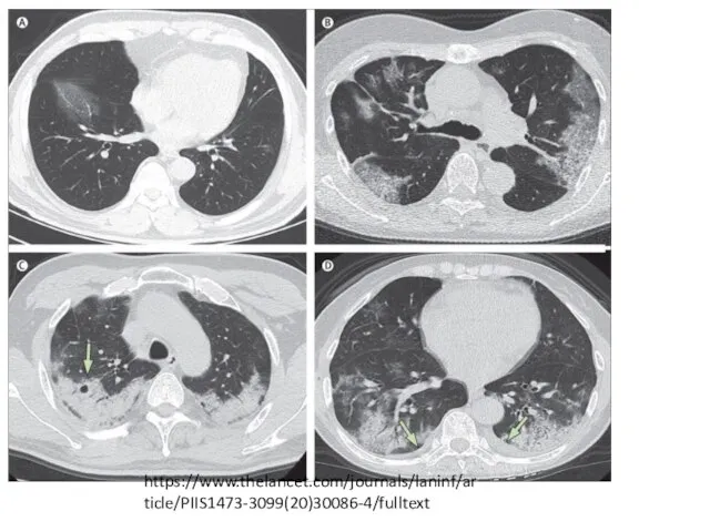 https://www.thelancet.com/journals/laninf/article/PIIS1473-3099(20)30086-4/fulltext