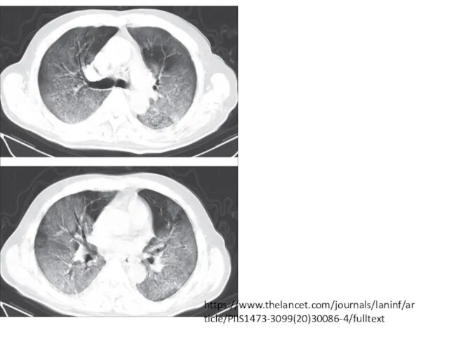 https://www.thelancet.com/journals/laninf/article/PIIS1473-3099(20)30086-4/fulltext