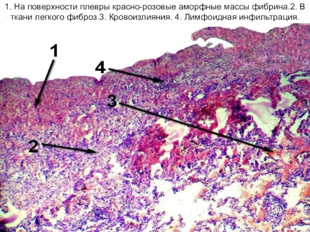 1. На поверхности плевры красно-розовые аморфные массы фибрина.2. В ткани легкого фиброз.3. Кровоизлияния. 4. Лимфоидная инфильтрация.