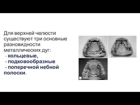 Для верхней челюсти существуют три основные разновидности металлических дуг: - кольцевые,