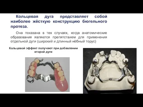 Кольцевая дуга представляет собой наиболее жёсткую конструкцию бюгельного протеза. Она показана