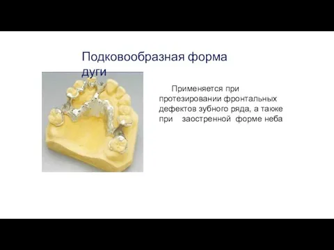 Применяется при протезировании фронтальных дефектов зубного ряда, а также при заостренной форме неба Подковообразная форма дуги
