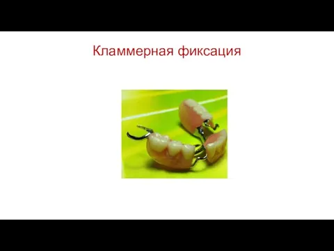 Кламмерная фиксация