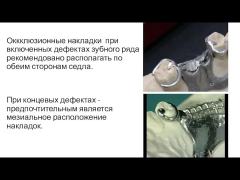 Оккклюзионные накладки при включенных дефектах зубного ряда рекомендовано располагать по обеим