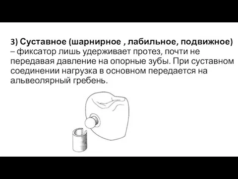 3) Суставное (шарнирное , лабильное, подвижное) – фиксатор лишь удерживает протез,