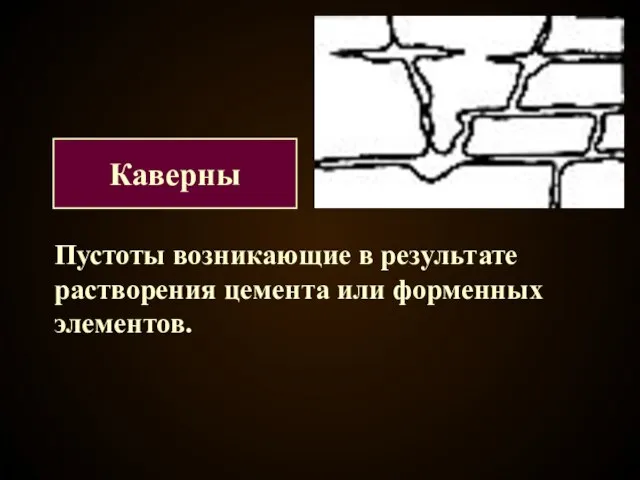 Пустоты возникающие в результате растворения цемента или форменных элементов. Каверны