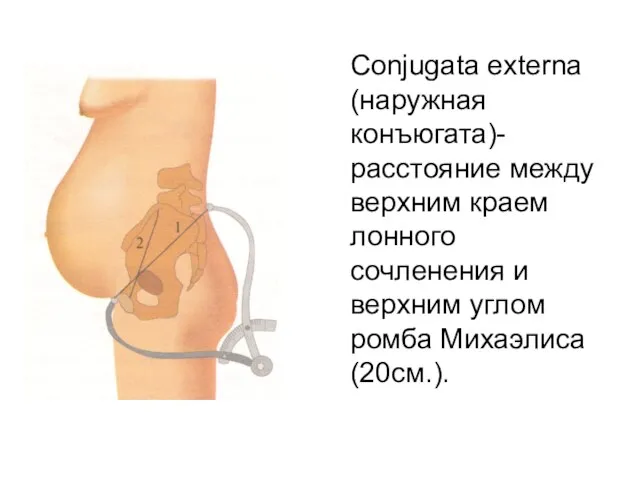 Сonjugata externa (наружная конъюгата)- расстояние между верхним краем лонного сочленения и верхним углом ромба Михаэлиса (20см.).