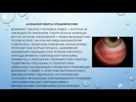 4.КОНЬЮНКТИВИТЫ СПЕЦИФИЧЕСКИЕ ВОЗНИКАЕТ ОБЫЧНО У МОЛОДЫХ ЛЮДЕЙ, У КОТОРЫХ НЕ НАБЛЮДАЕТСЯ