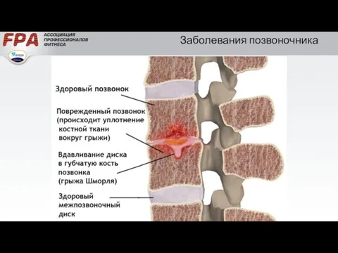 Заболевания позвоночника