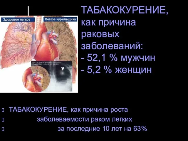 ТАБАКОКУРЕНИЕ, как причина раковых заболеваний: - 52,1 % мужчин - 5,2