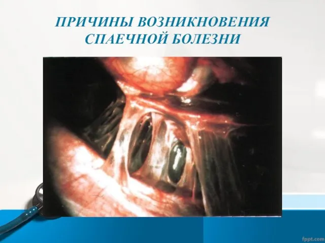 ПРИЧИНЫ ВОЗНИКНОВЕНИЯ СПАЕЧНОЙ БОЛЕЗНИ