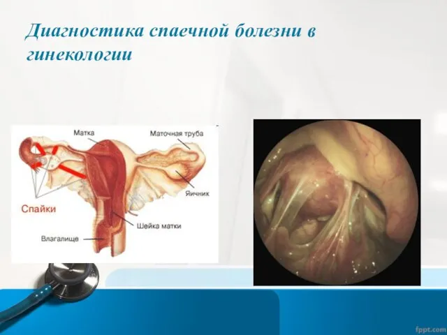 Диагностика спаечной болезни в гинекологии