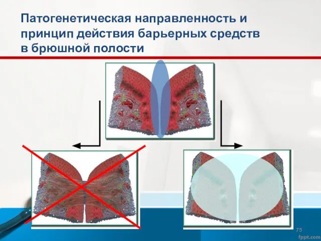 Патогенетическая направленность и принцип действия барьерных средств в брюшной полости