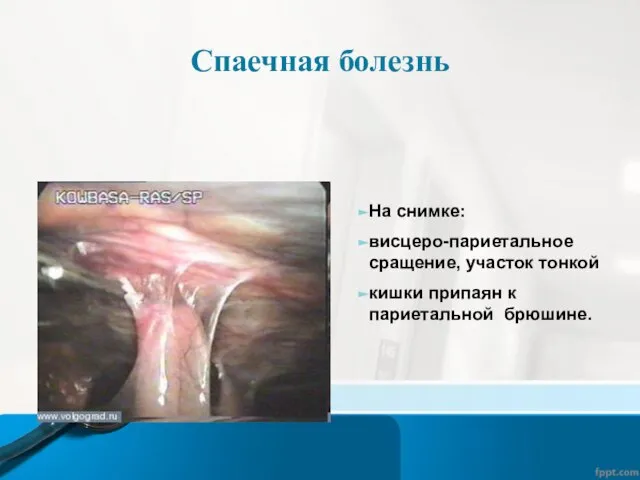 Спаечная болезнь На снимке: висцеро-париетальное сращение, участок тонкой кишки припаян к париетальной брюшине.