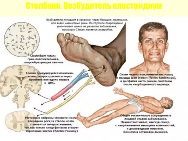 Столбняк. Возбудитель клостридиум