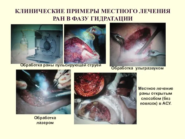 КЛИНИЧЕСКИЕ ПРИМЕРЫ МЕСТНОГО ЛЕЧЕНИЯ РАН В ФАЗУ ГИДРАТАЦИИ Обработка раны пульсирующей