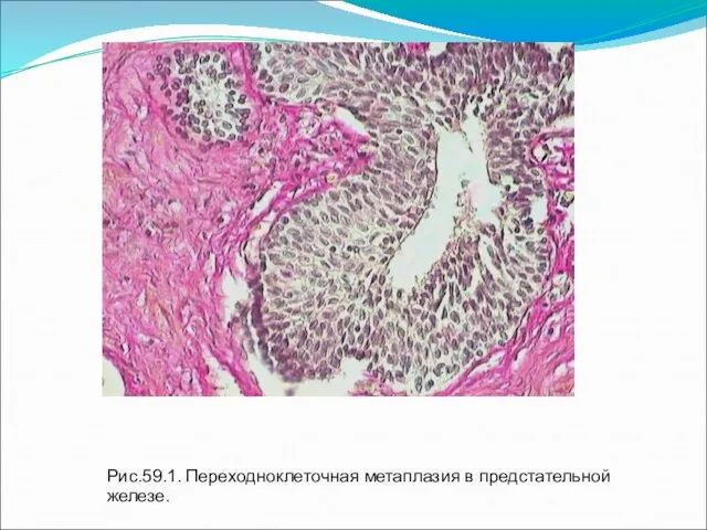 Рис.59.1. Переходноклеточная метаплазия в предстательной железе.
