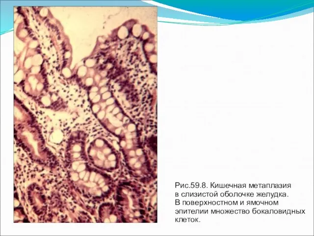 Рис.59.8. Кишечная метаплазия в слизистой оболочке желудка. В поверхностном и ямочном эпителии множество бокаловидных клеток.