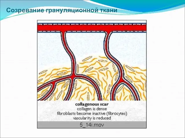 Созревание грануляционной ткани