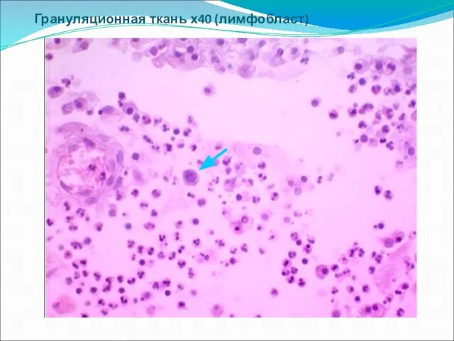 Грануляционная ткань х40 (лимфобласт)
