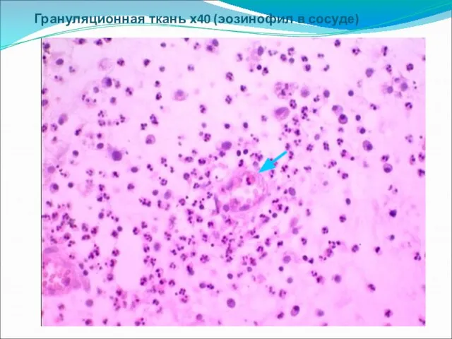 Грануляционная ткань х40 (эозинофил в сосуде)