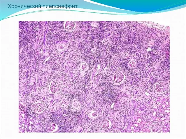Хронический пиелонефрит