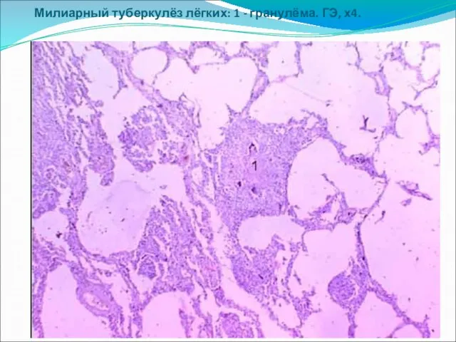 Милиарный туберкулёз лёгких: 1 - гранулёма. ГЭ, х4.