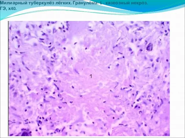 Милиарный туберкулёз лёгких. Гранулёма: 1 - казеозный некроз. ГЭ, х40.