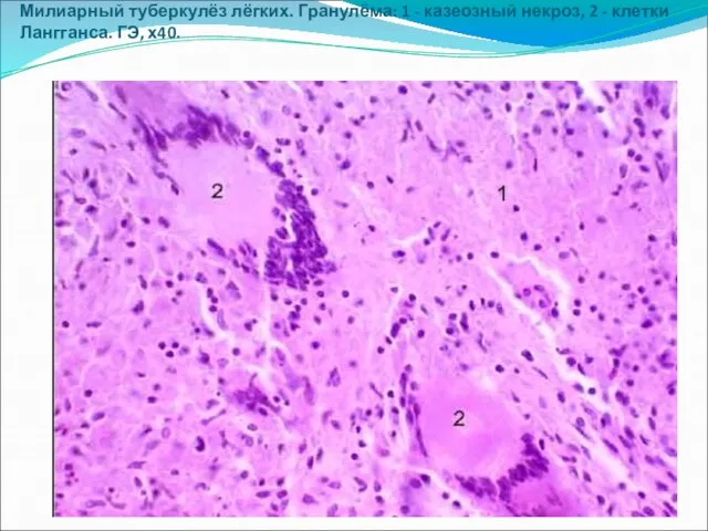 Милиарный туберкулёз лёгких. Гранулёма: 1 - казеозный некроз, 2 - клетки Лангганса. ГЭ, х40.