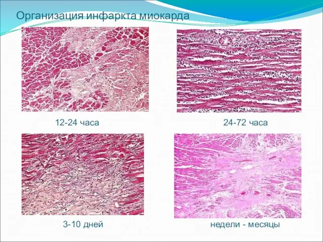 Организация инфаркта миокарда 12-24 часа 24-72 часа 3-10 дней недели - месяцы