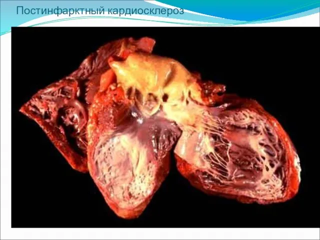 Постинфарктный кардиосклероз