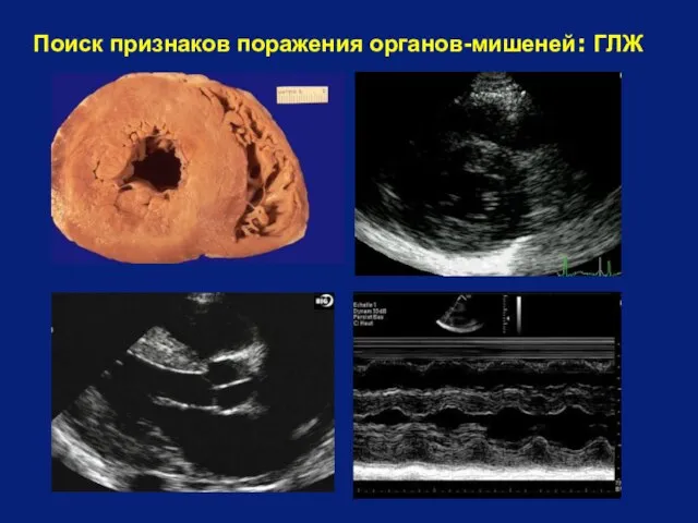 Поиск признаков поражения органов-мишеней: ГЛЖ