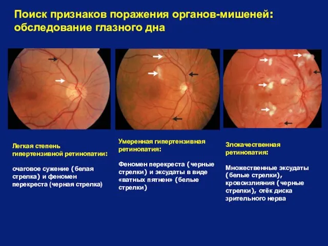 Поиск признаков поражения органов-мишеней: обследование глазного дна Умеренная гипертензивная ретинопатия: Феномен