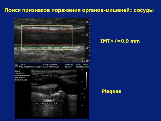 Поиск признаков поражения органов-мишеней: сосуды IMT>/=0.9 mm Plaques