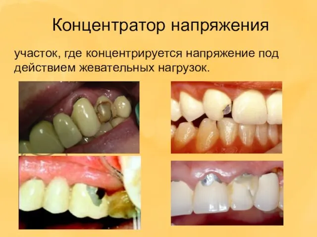 Концентратор напряжения участок, где концентрируется напряжение под действием жевательных нагрузок.