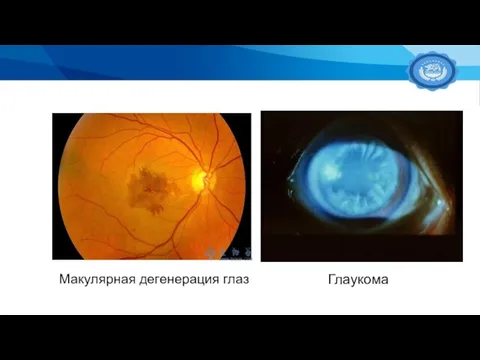 Макулярная дегенерация глаз Глаукома