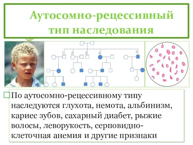 Аутосомно-рецессивный тип наследования По аутосомно-рецессивному типу наследуются глухота, немота, альбинизм, кариес