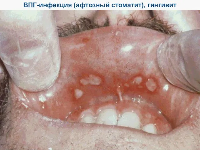 ВПГ-инфекция (афтозный стоматит), гингивит