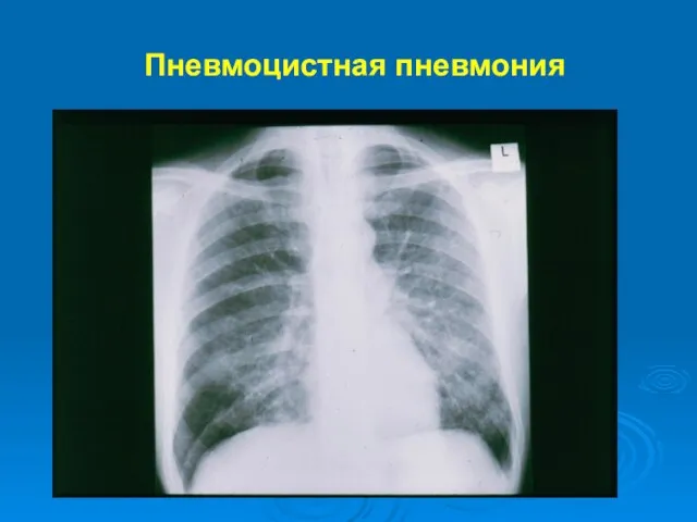 Пневмоцистная пневмония