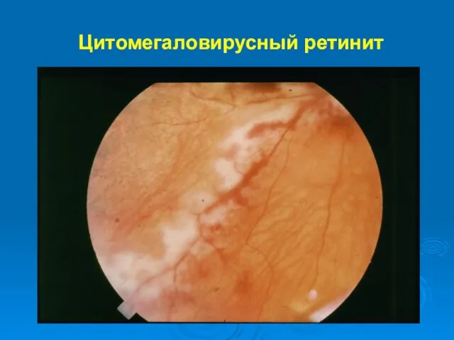 Цитомегаловирусный ретинит