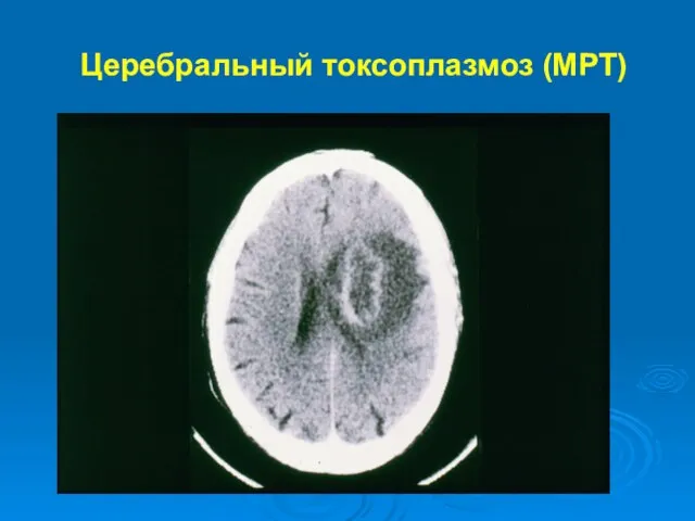 Церебральный токсоплазмоз (МРТ)