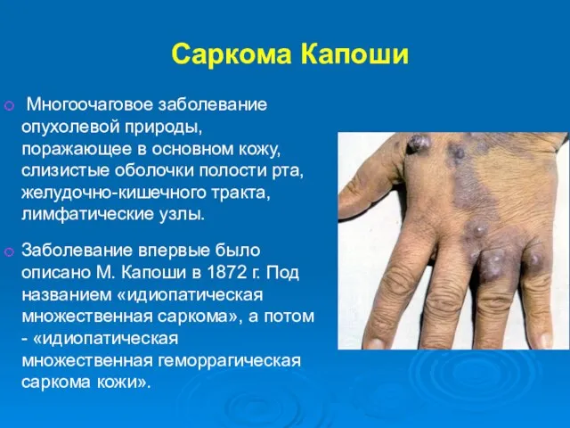 Саркома Капоши Многоочаговое заболевание опухолевой природы, поражающее в основном кожу, слизистые