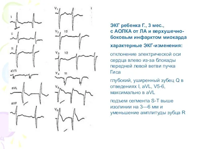 ЭКГ ребенка Г., 3 мес., с АОЛКА от ЛА и верхушечно-боковым