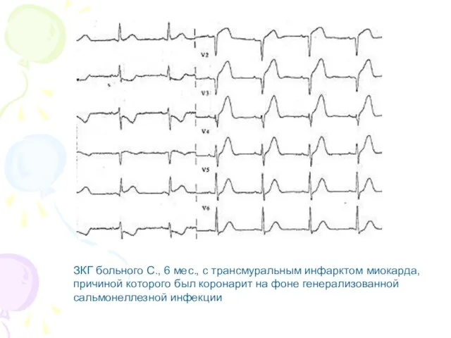 ЗКГ больного С., 6 мес., с трансмуральным инфарктом миокарда, причиной которого