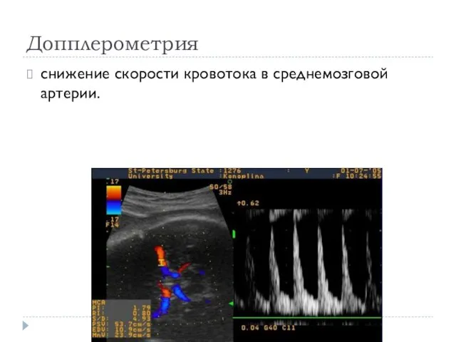 Допплерометрия снижение скорости кровотока в среднемозговой артерии.