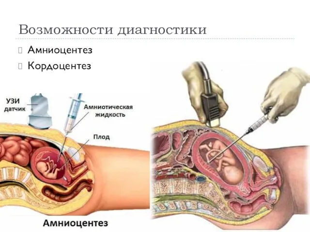 Возможности диагностики Амниоцентез Кордоцентез