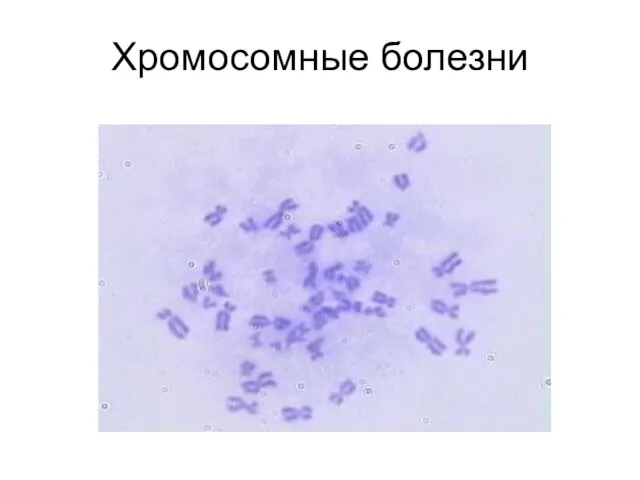 Хромосомные болезни